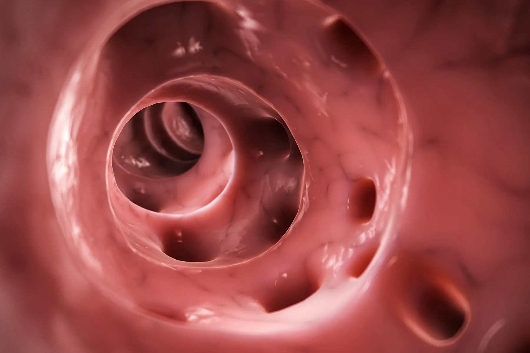 Diverticulitis Treatment: How to Treat It and Recovery Time